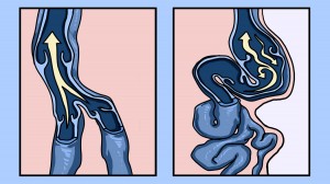 varicocele-1 (1)